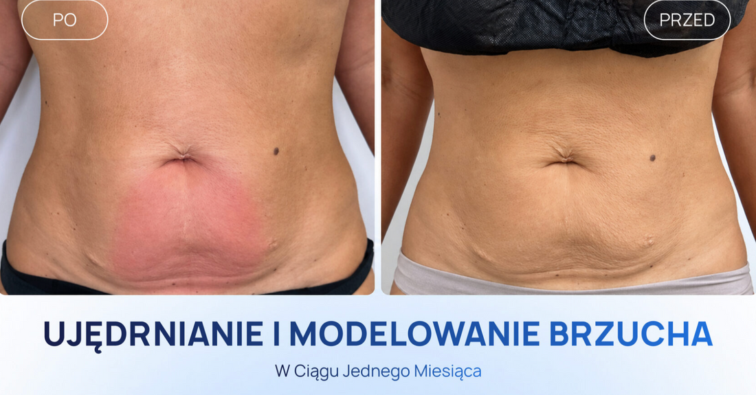 Jak Stworzyć Protokół Ujędrniający i Modelujący Brzuch? Case study z wykorzystaniem Zemits EndoLuxx Pro i Zemits Abigon Pro