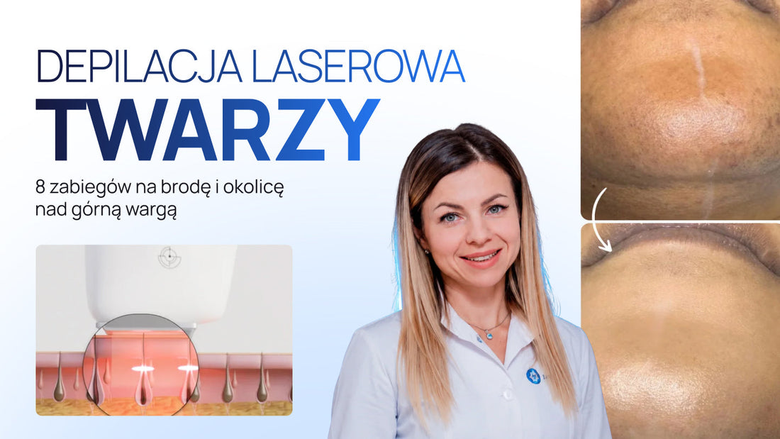 Depilacja laserowa twarzy: 8 zabiegów na brodę i okolicę nad górną wargą