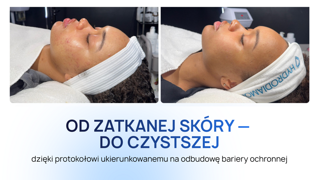 Jak stworzyć protokół skoncentrowany na odbudowie bariery hydrolipidowej dla skóry mieszanej i skłonnej do trądziku