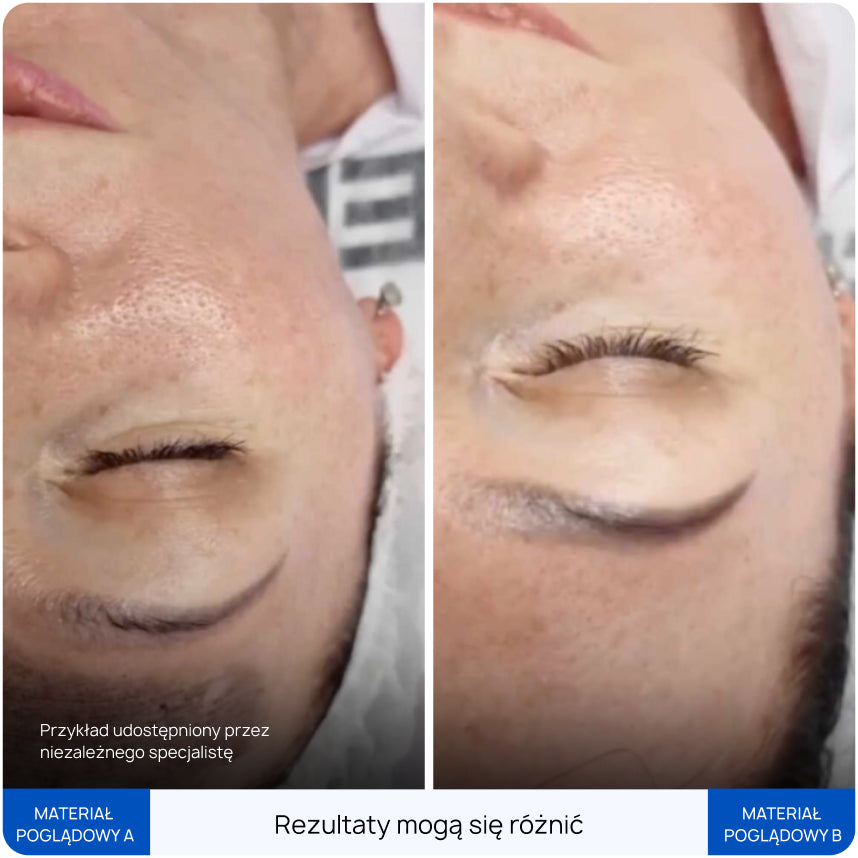 Zemits OgmaLaze NG
