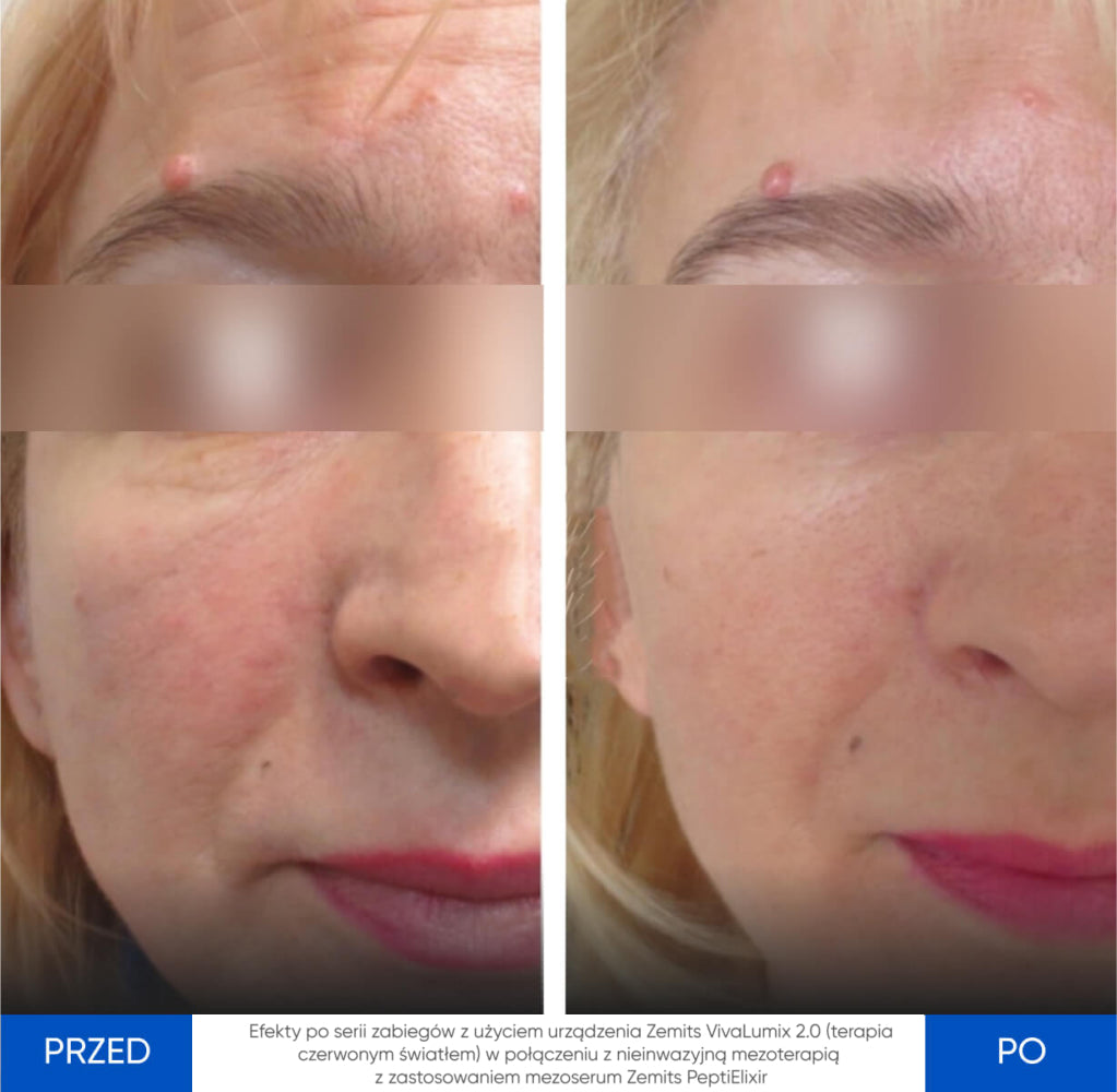 Before After Slide 1