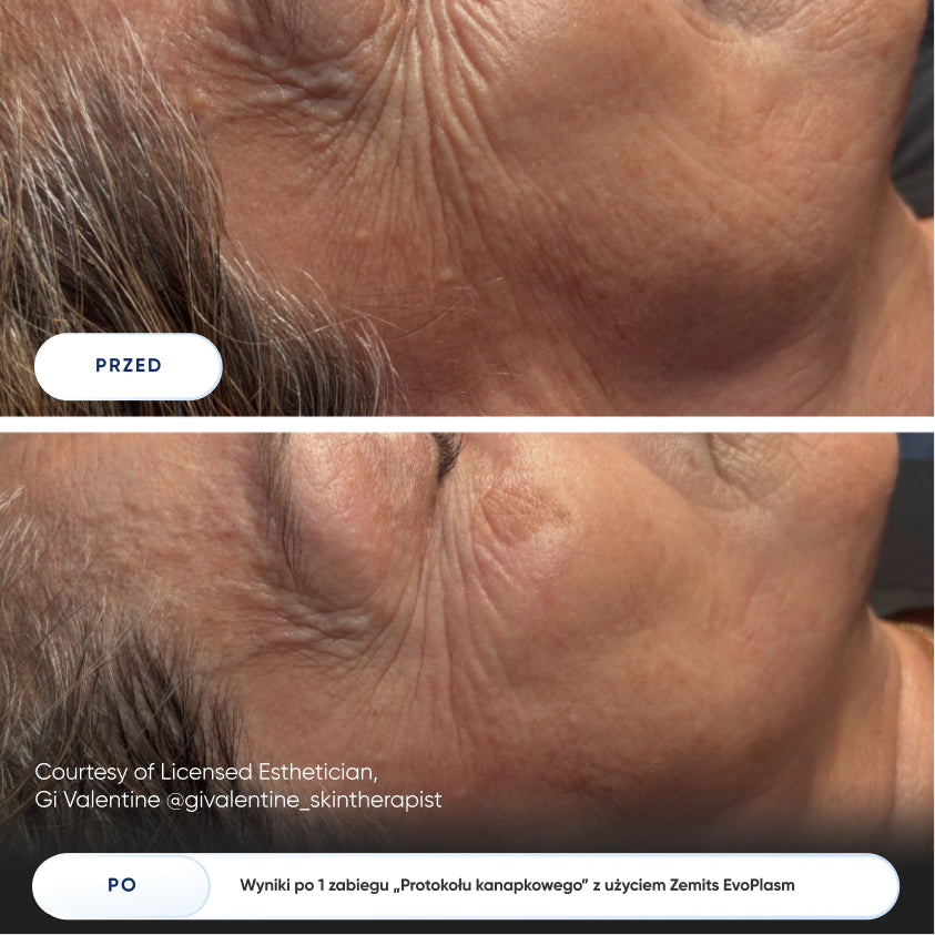 Before After Slide 1
