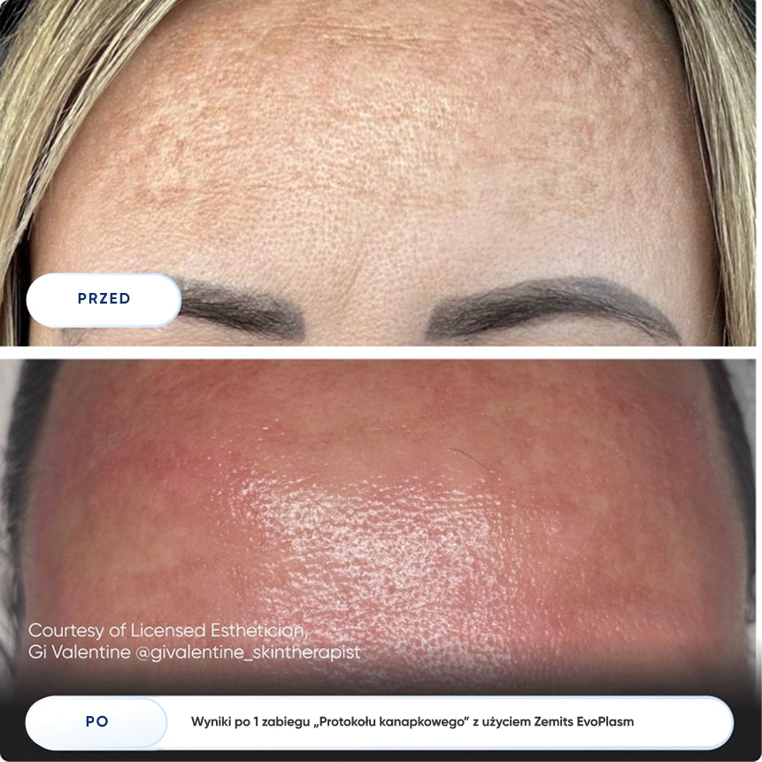 Before After Slide 4