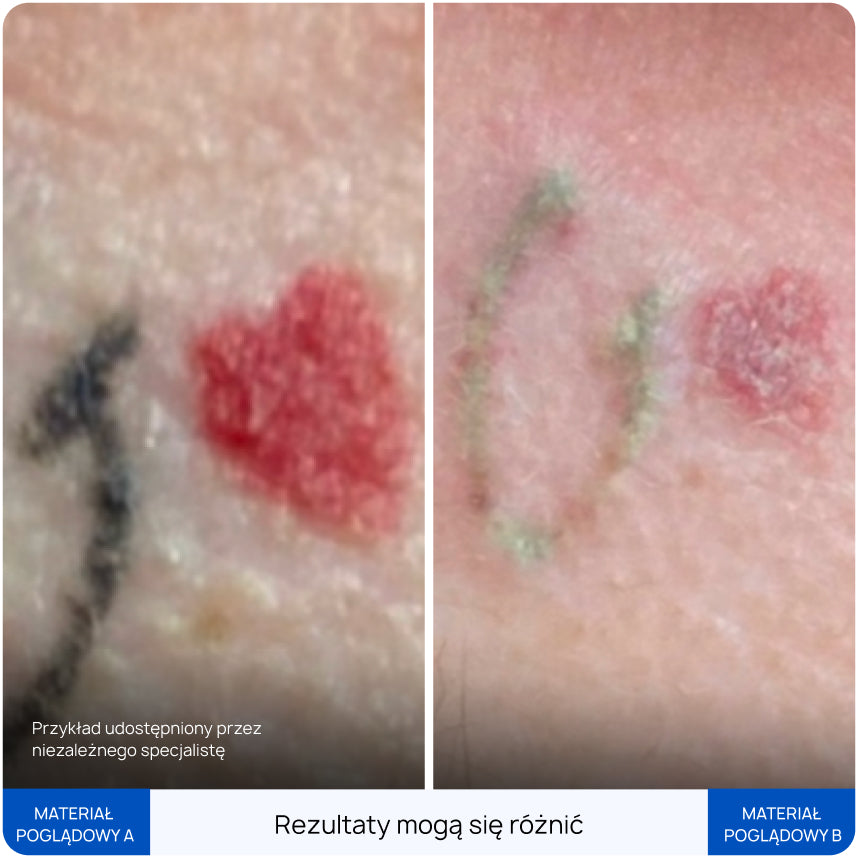 Before After Slide 11