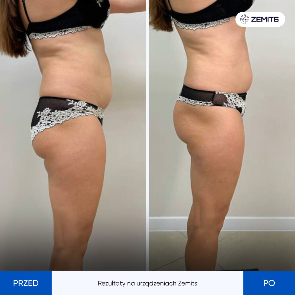 Before After Slide 1