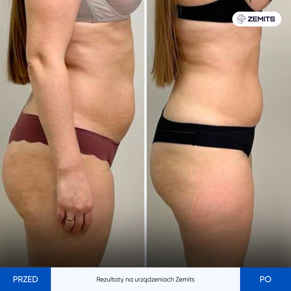 Before After Slide 2