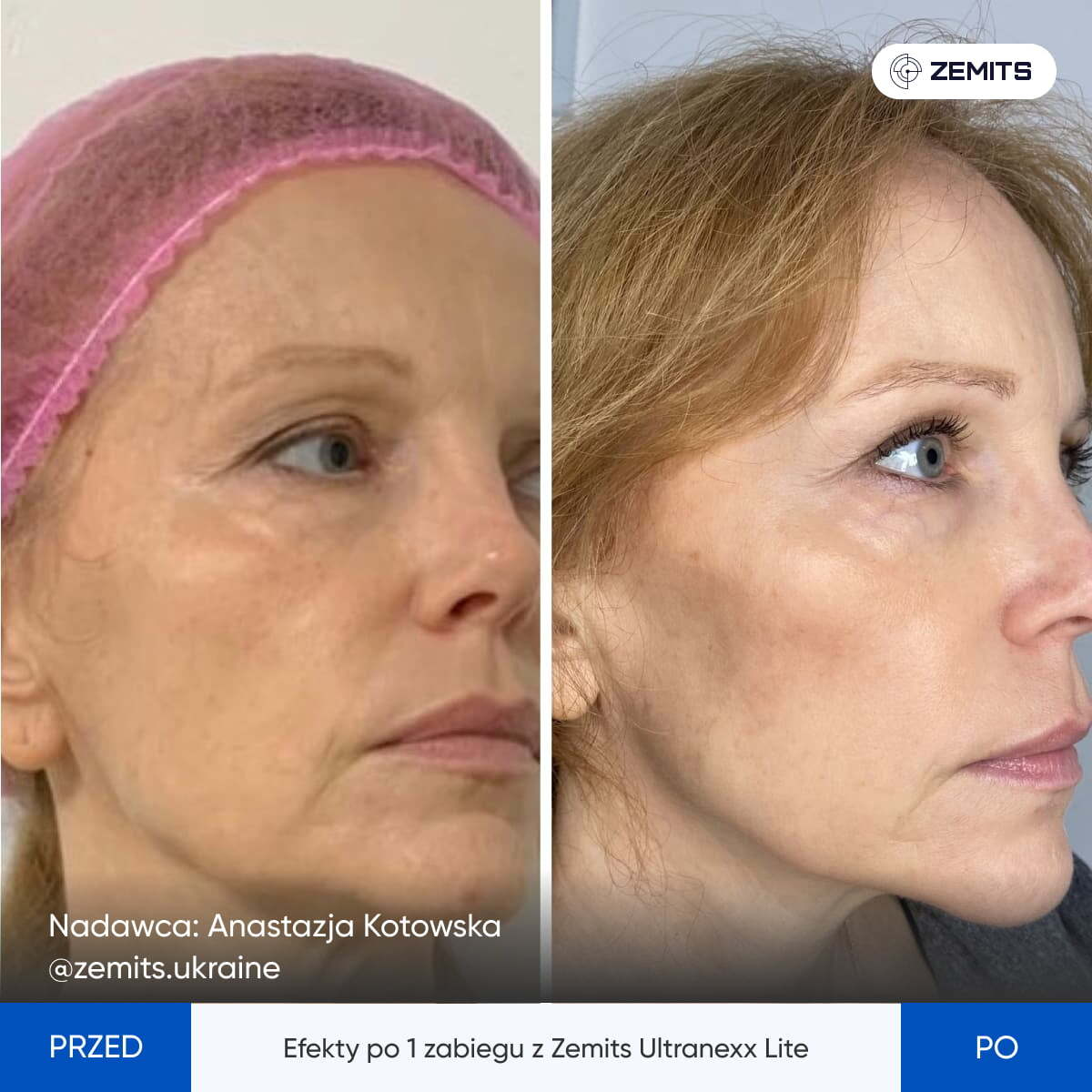 Before After Slide 1