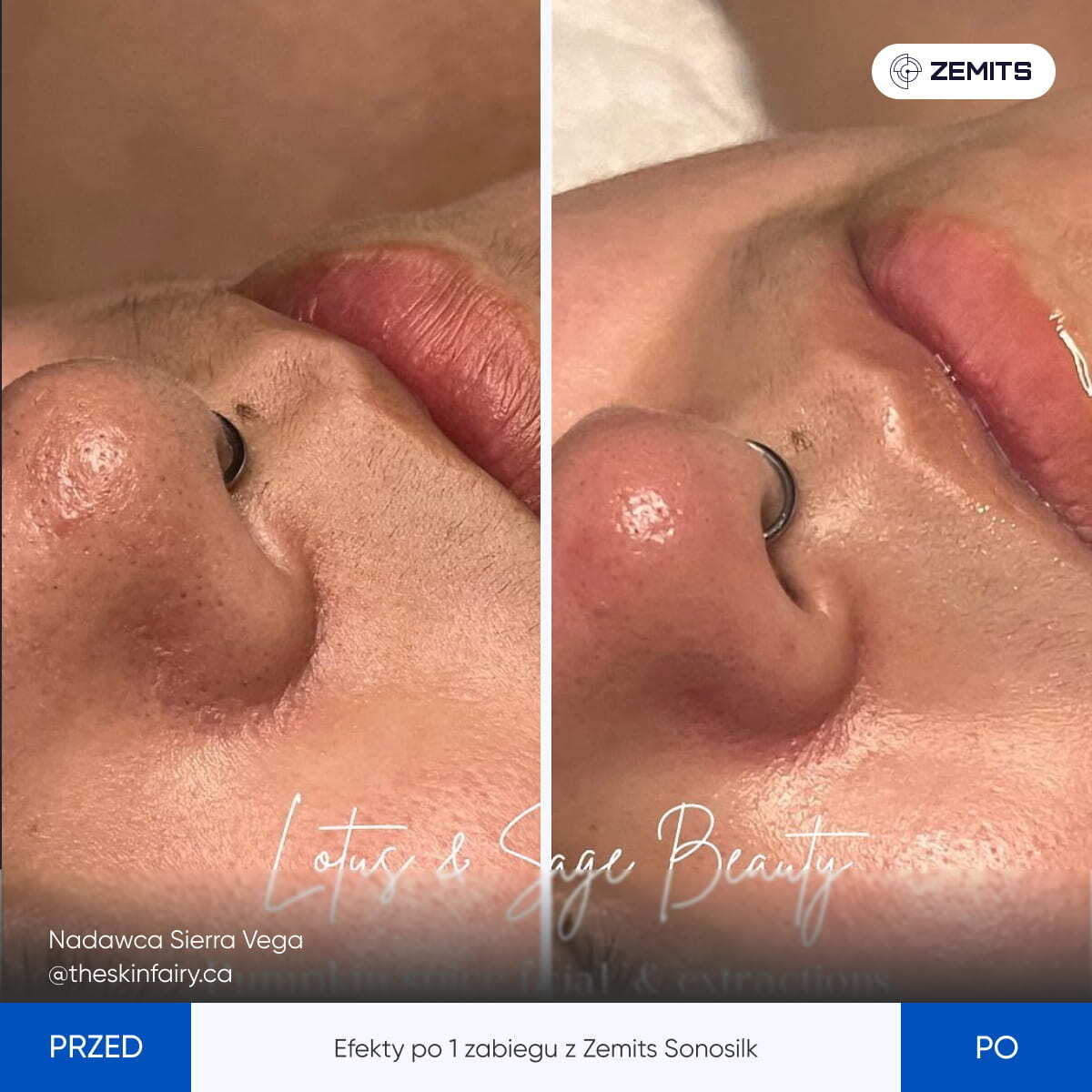 Before After Slide 1