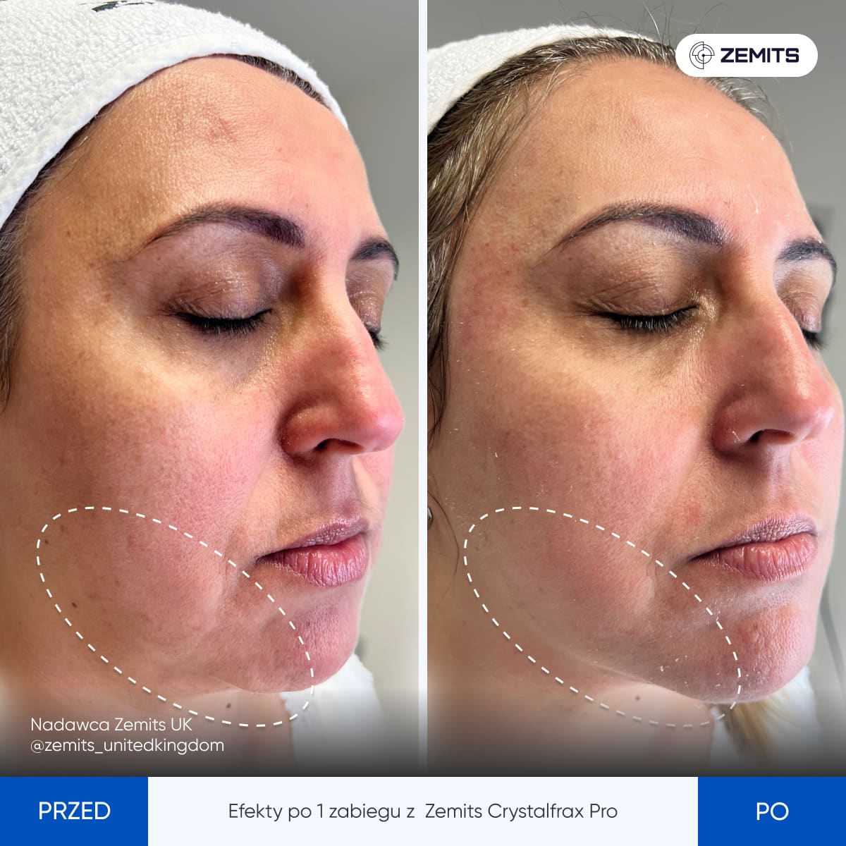 Before After Slide 4