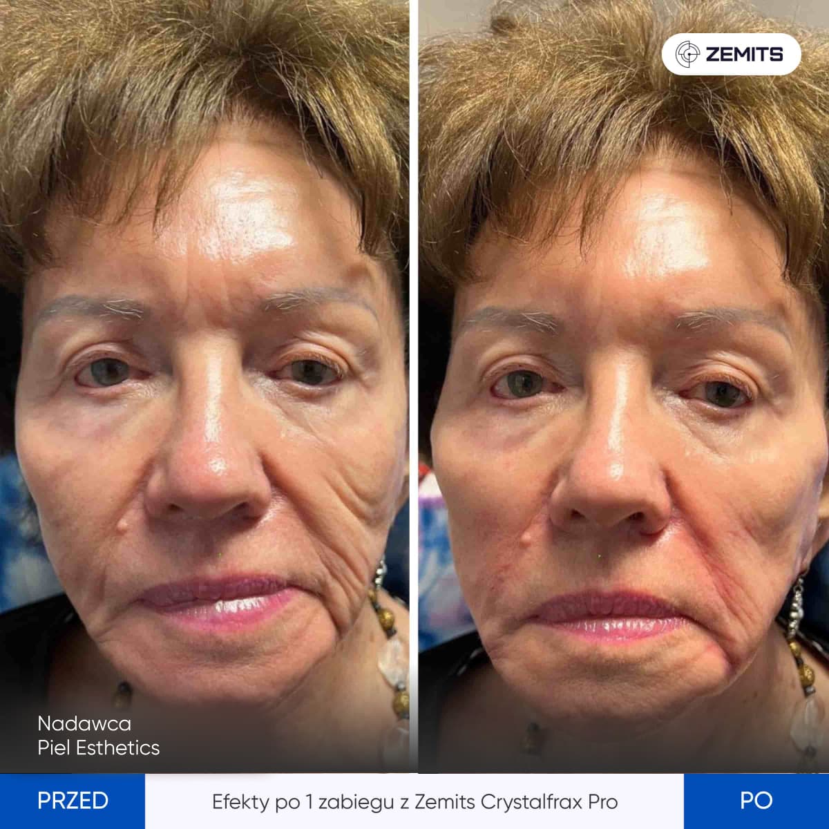 Before After Slide 5