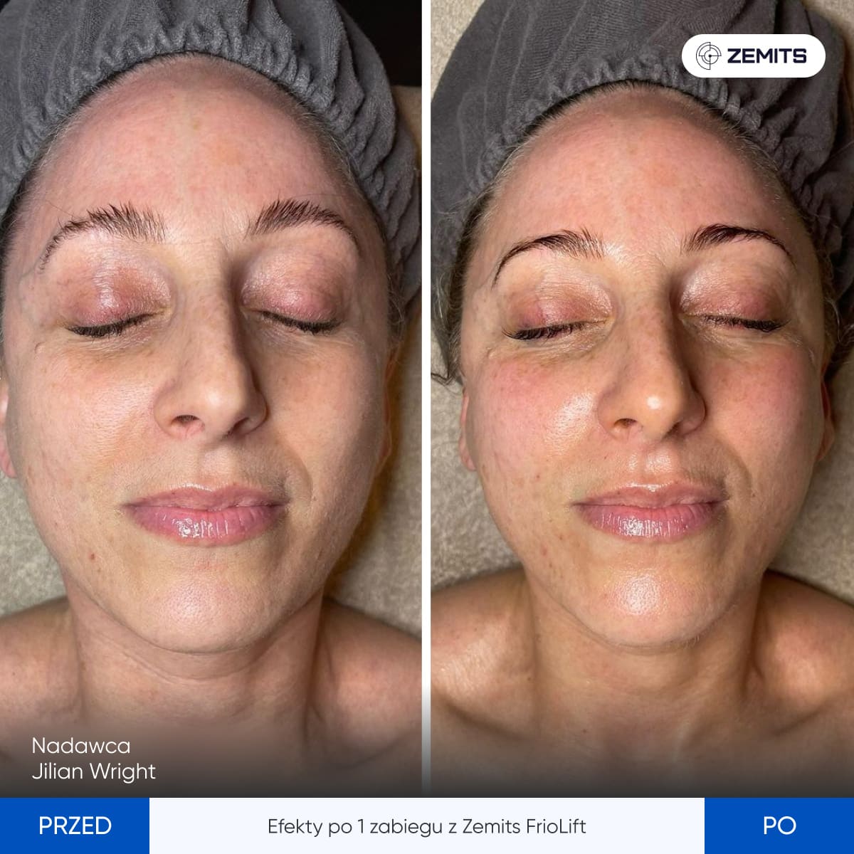 Before After Slide 4