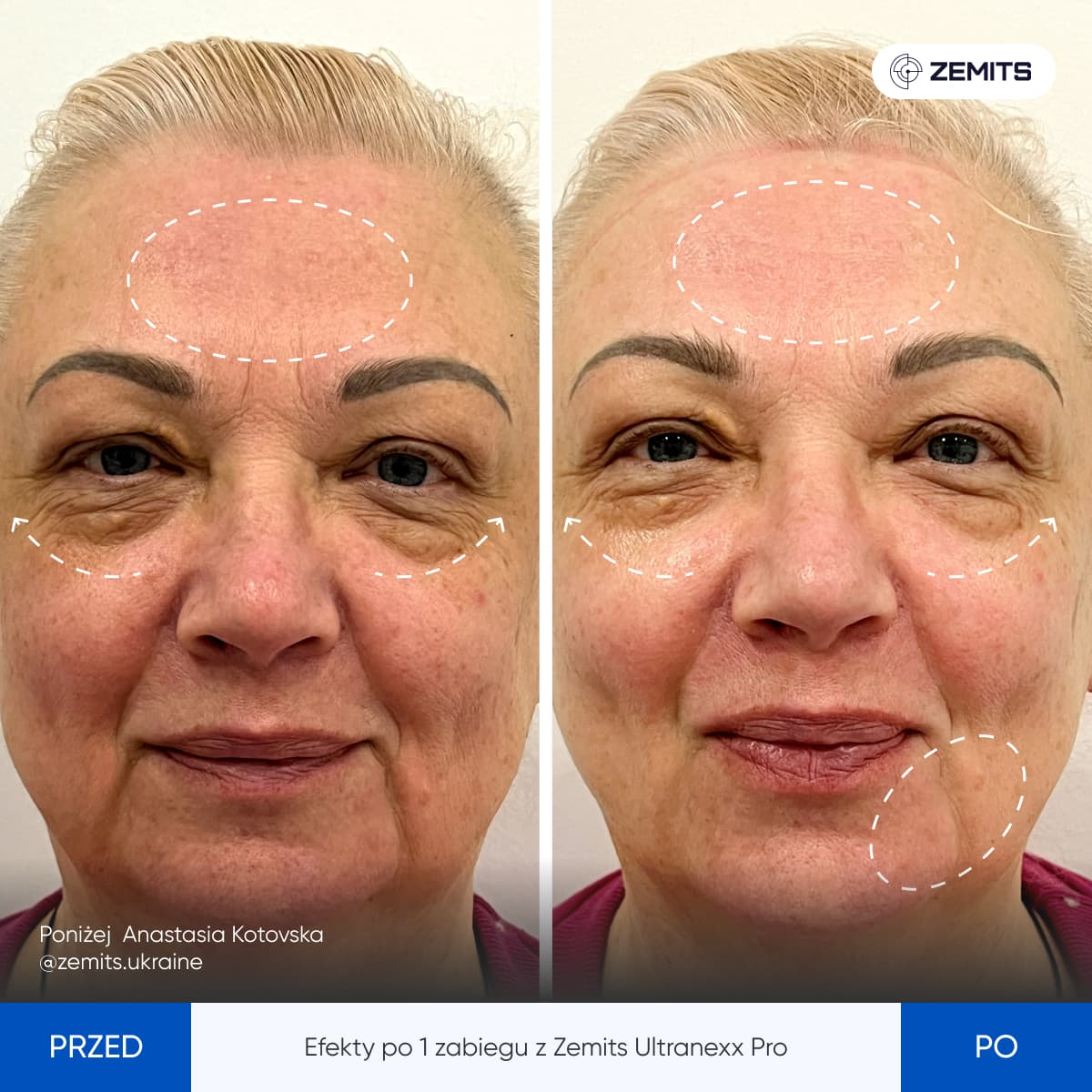 Before After Slide 5