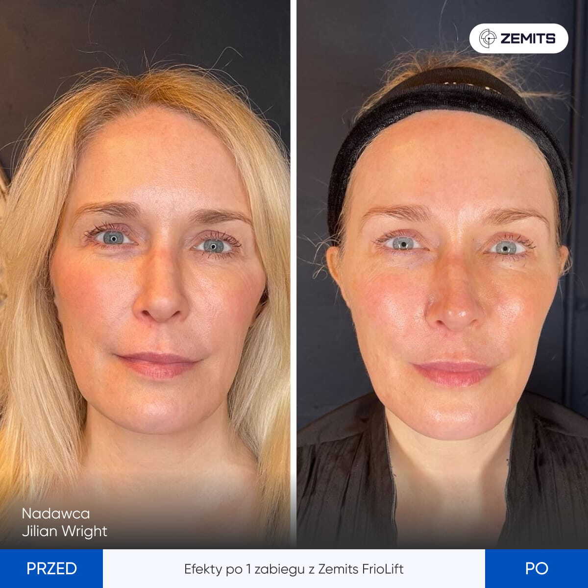 Before After Slide 7