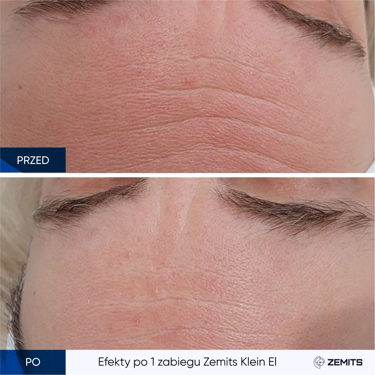 Before After Slide 1