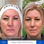 Zemits UltraNexx Lite