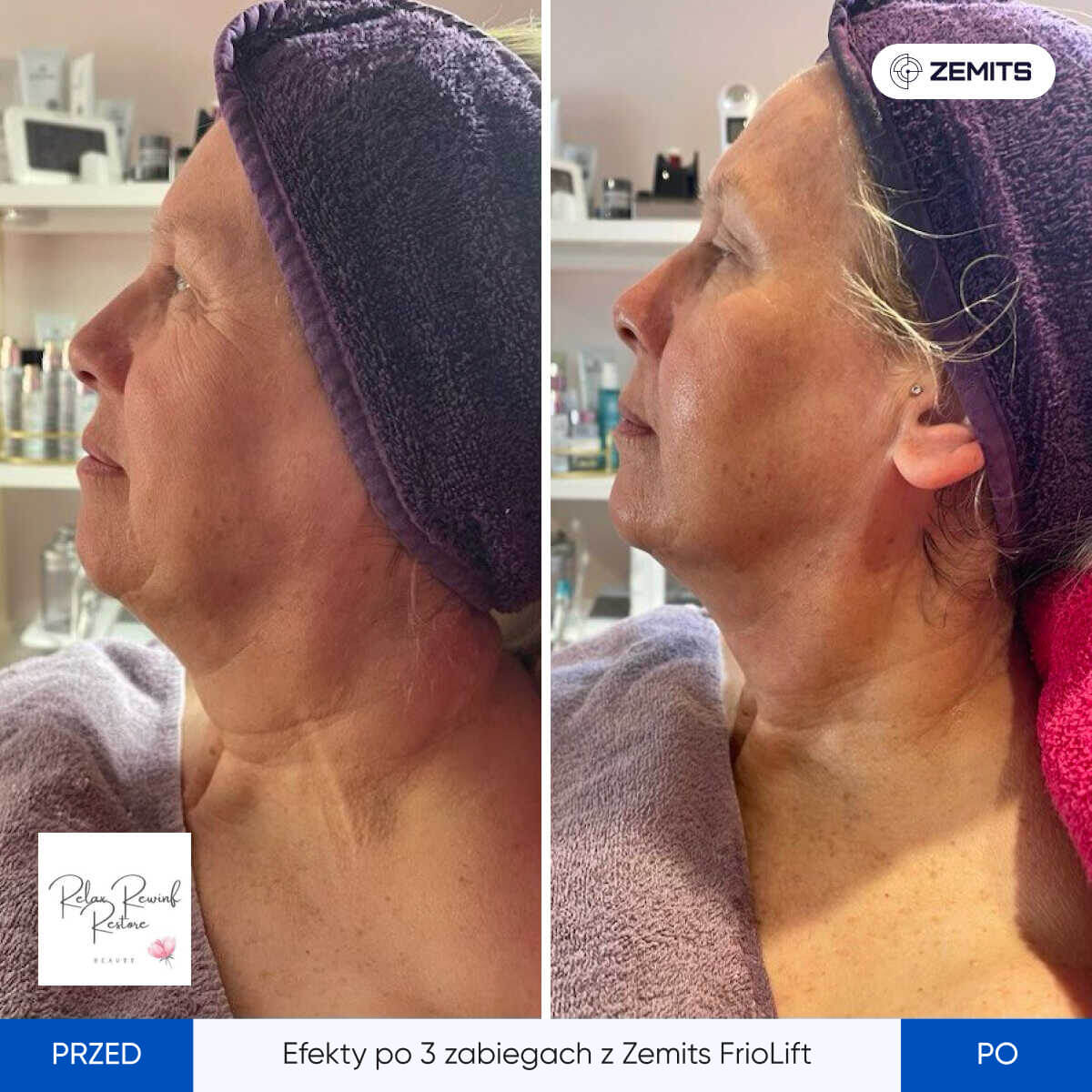 Before After Slide 8