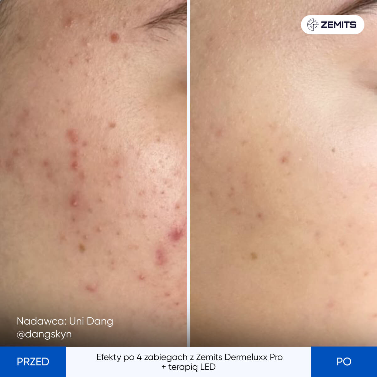 Before After Slide 11