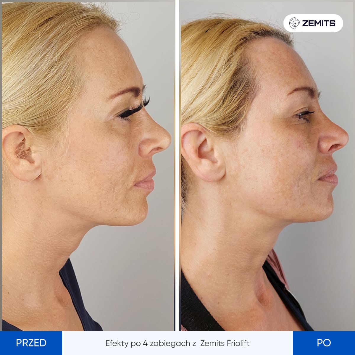 Before After Slide 9