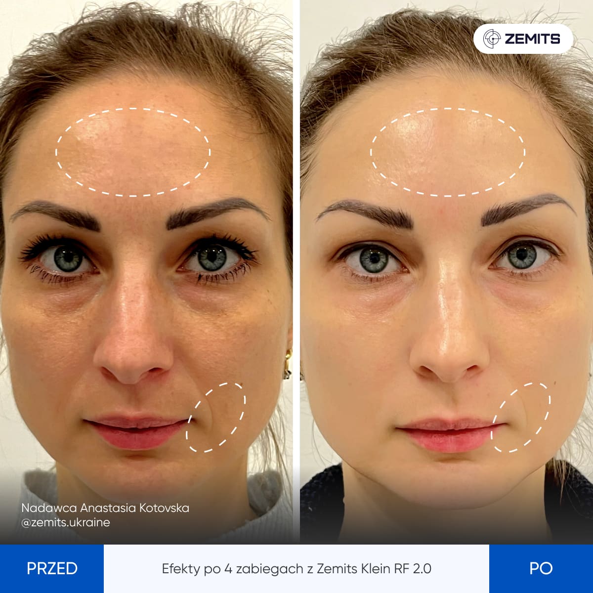 Before After Slide 8
