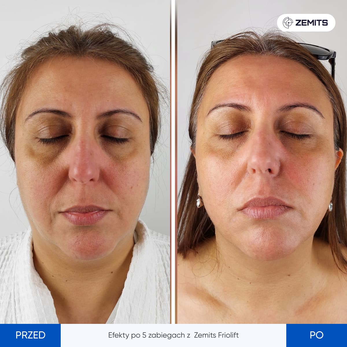 Before After Slide 13