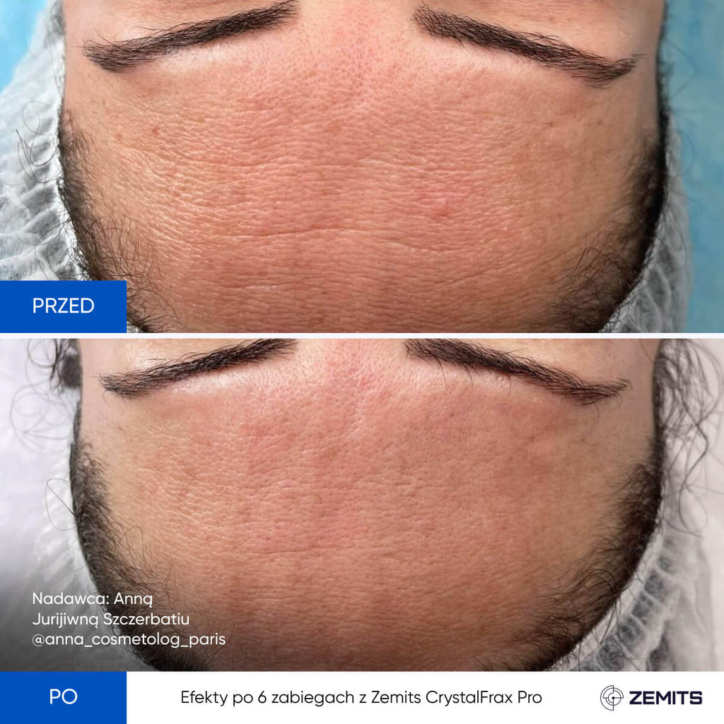 Zemits CrystalFrax Pro MD