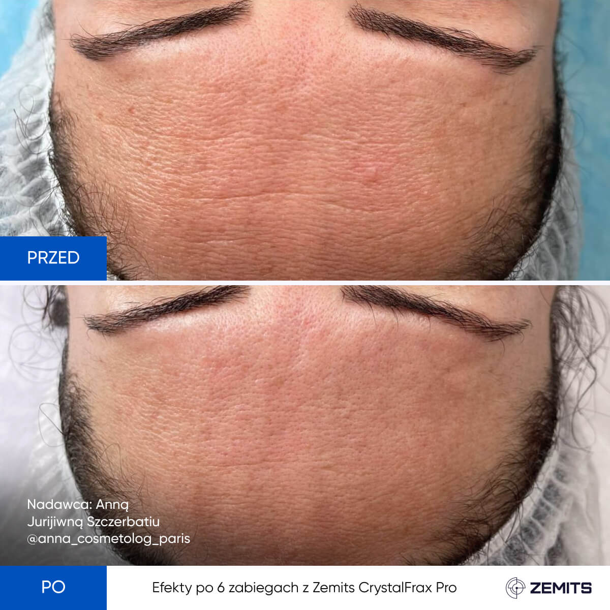 Zemits CrystalFrax Pro MD