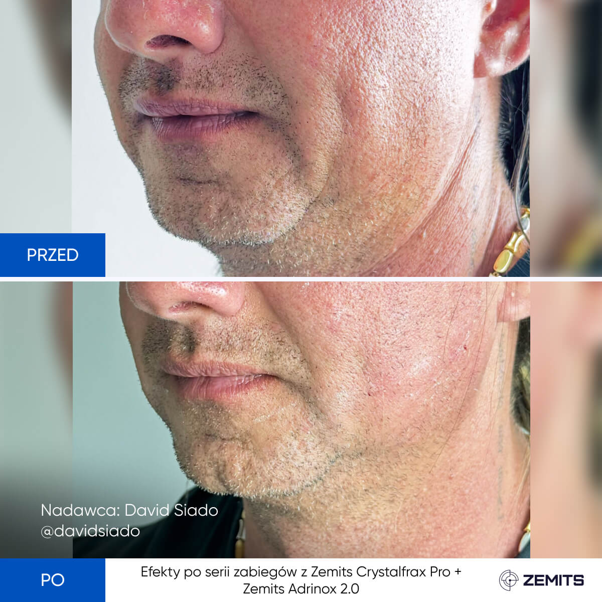 Before After Slide 5