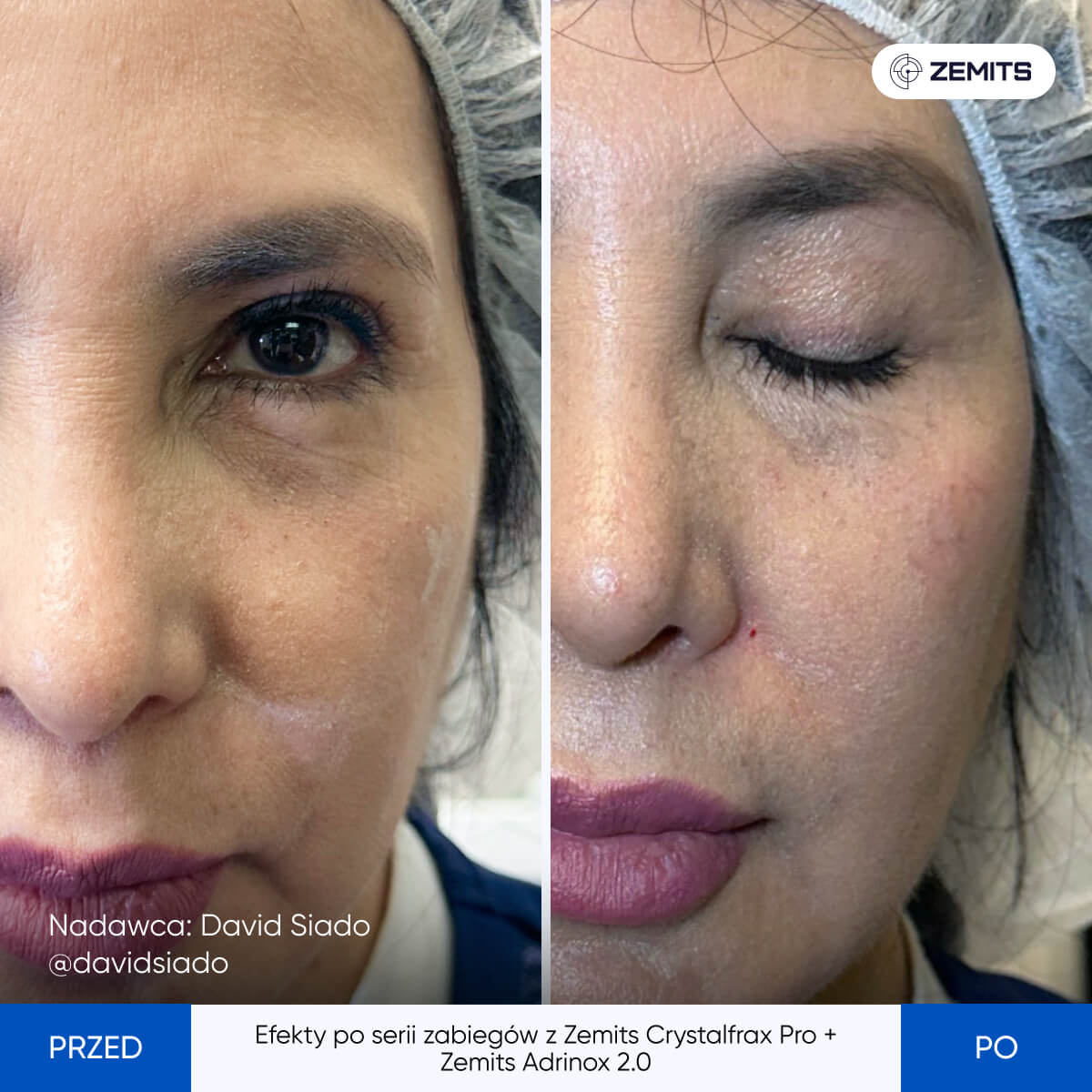 Before After Slide 6
