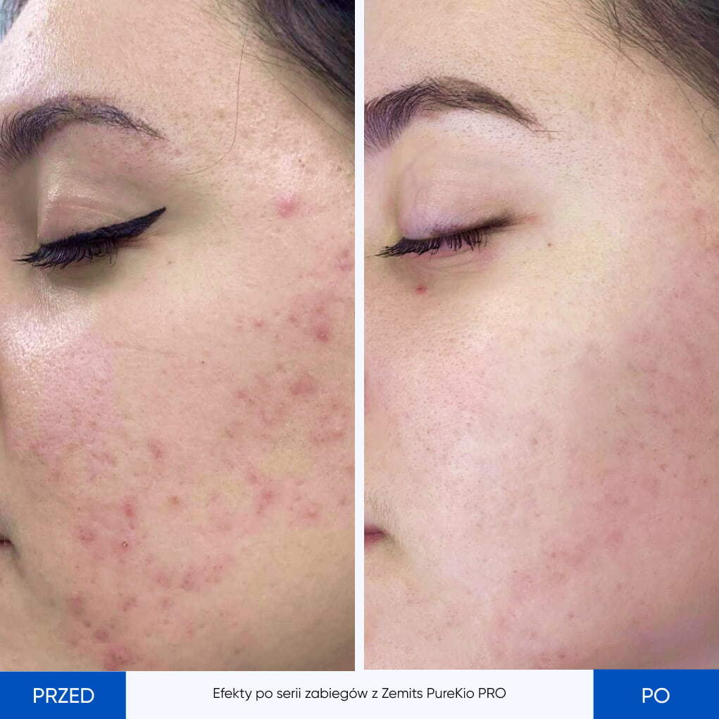 Before After Slide 1