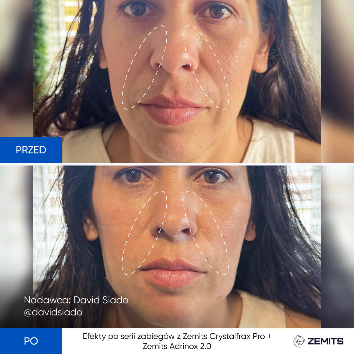 Before After Slide 16