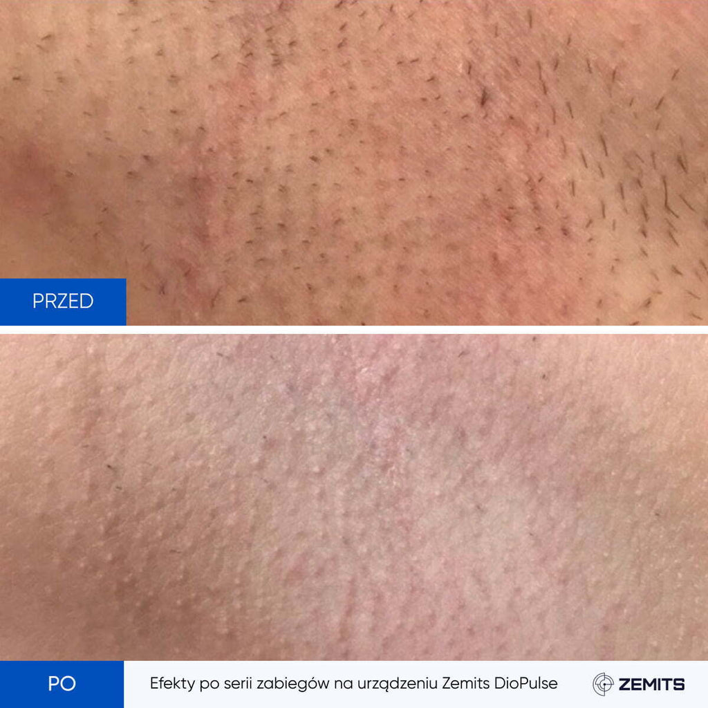 Zemits DioPulse Czterowiązkowy