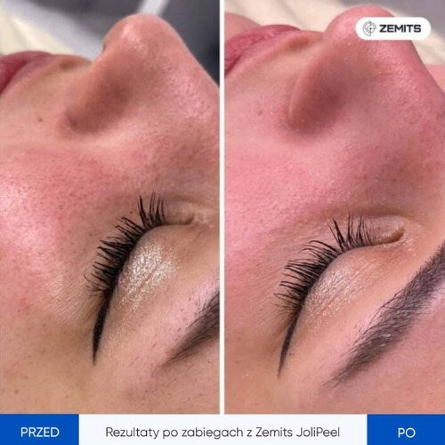 Zemits JoliPeel