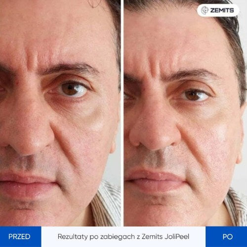 Zemits JoliPeel