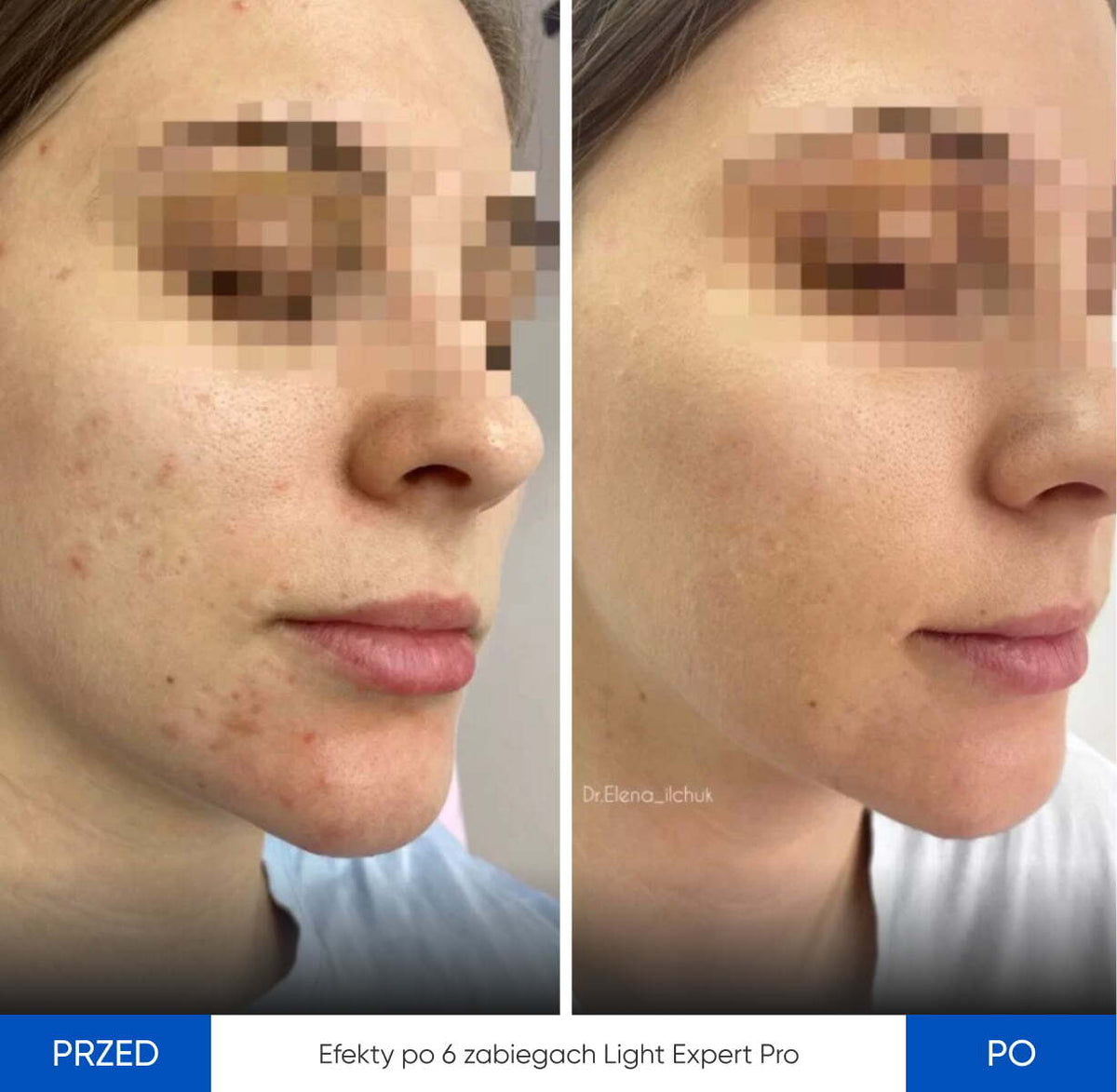 Before After Slide 4