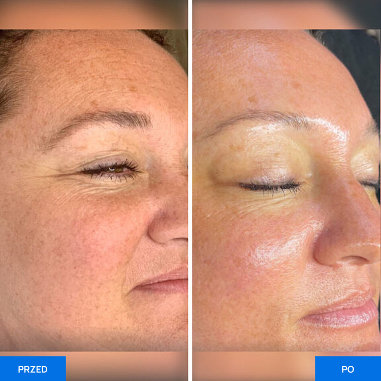 Before After Slide 1