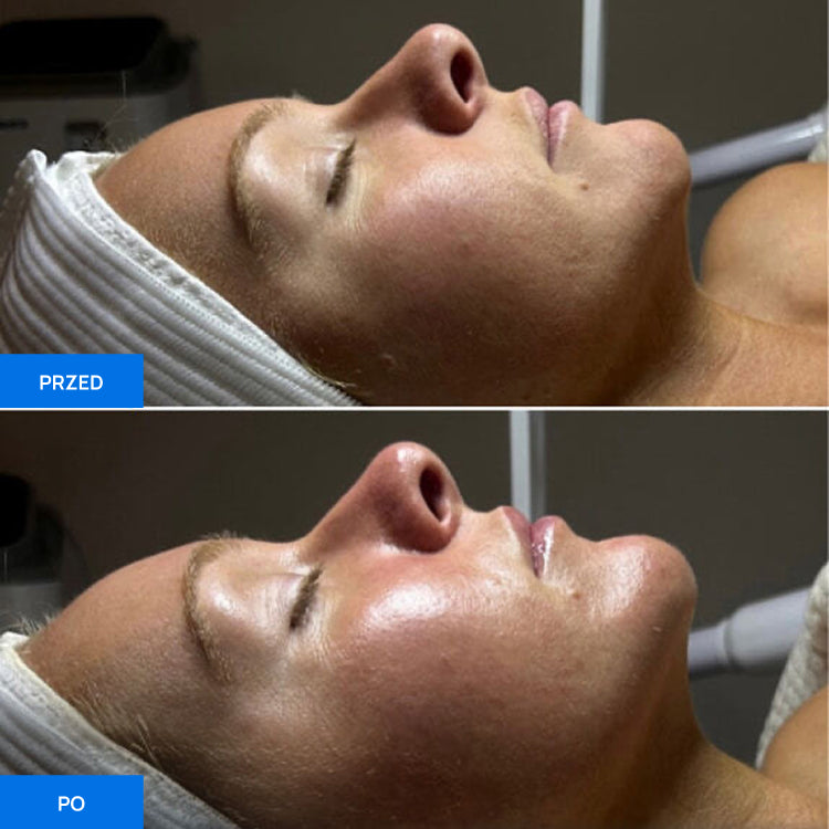 Before After Slide 4