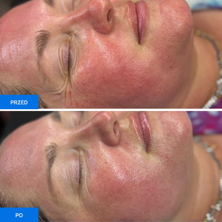 Before After Slide 1