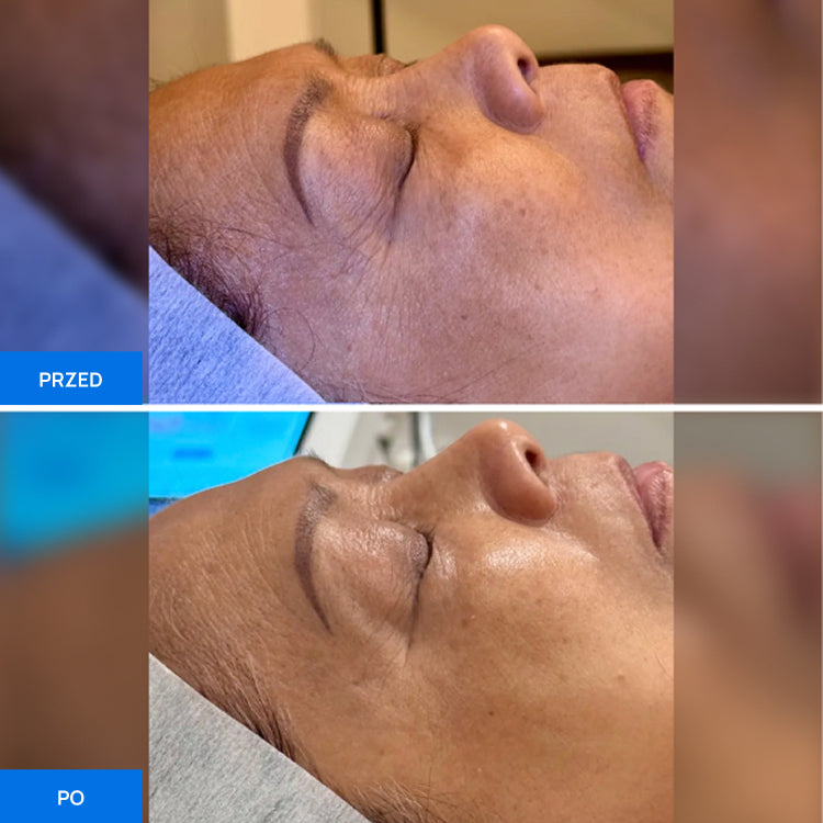 Before After Slide 3