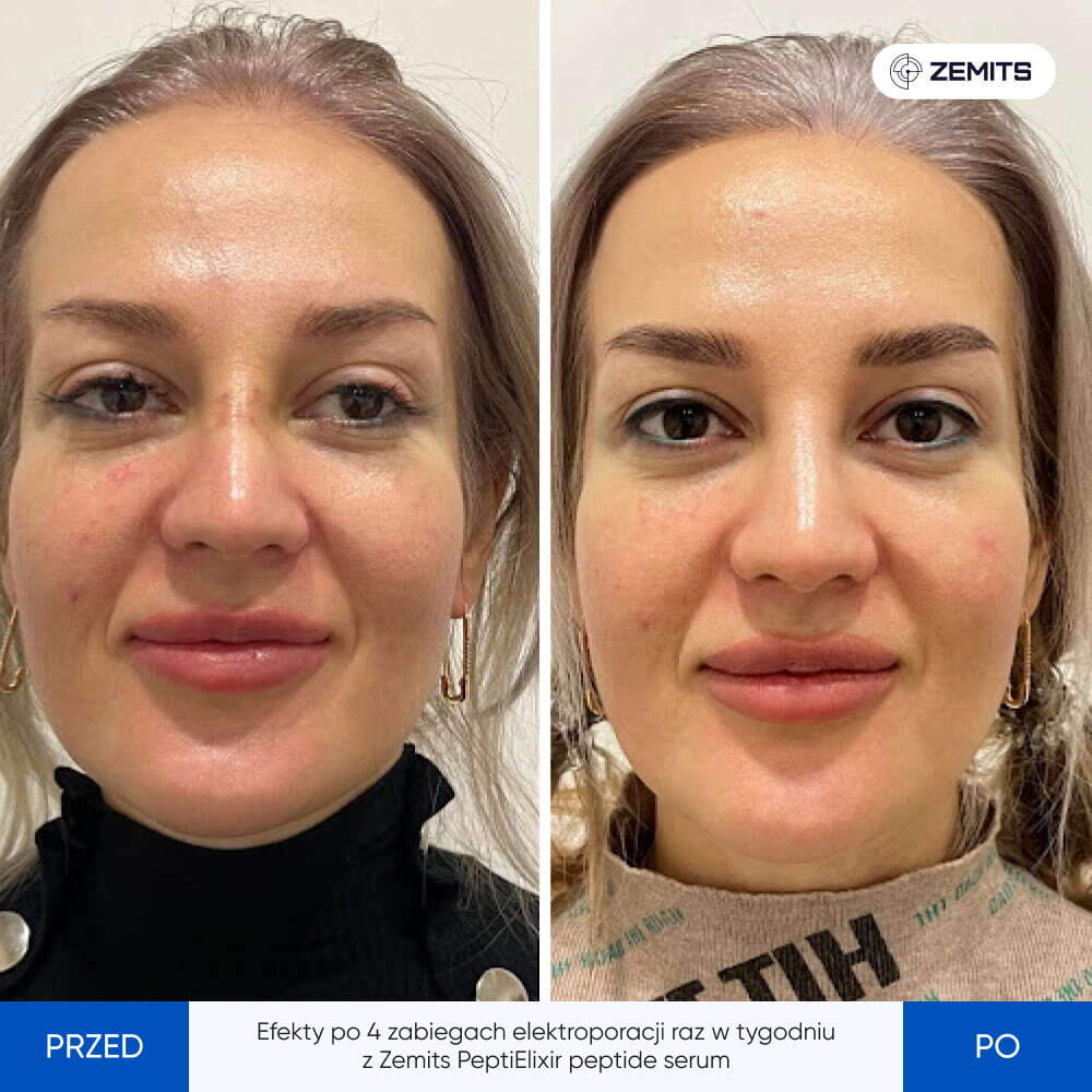 Before After Slide 3