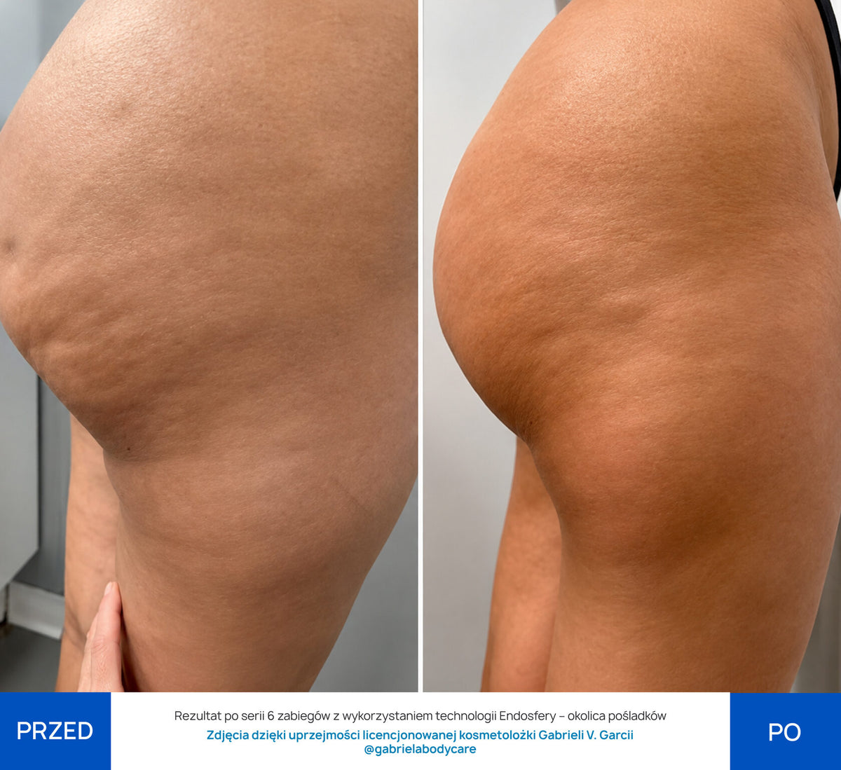 Before After Slide 1