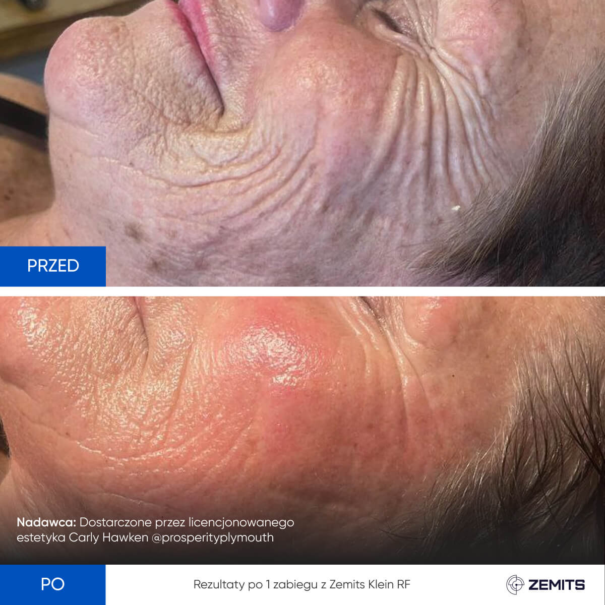 Before After Slide 11