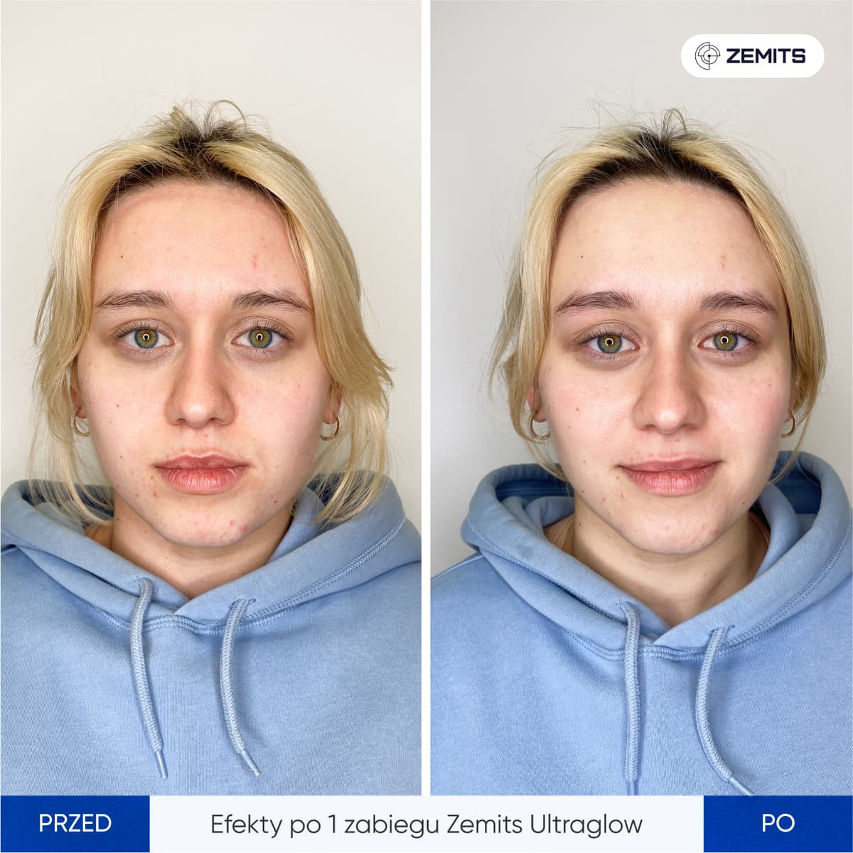 Before After Slide 1