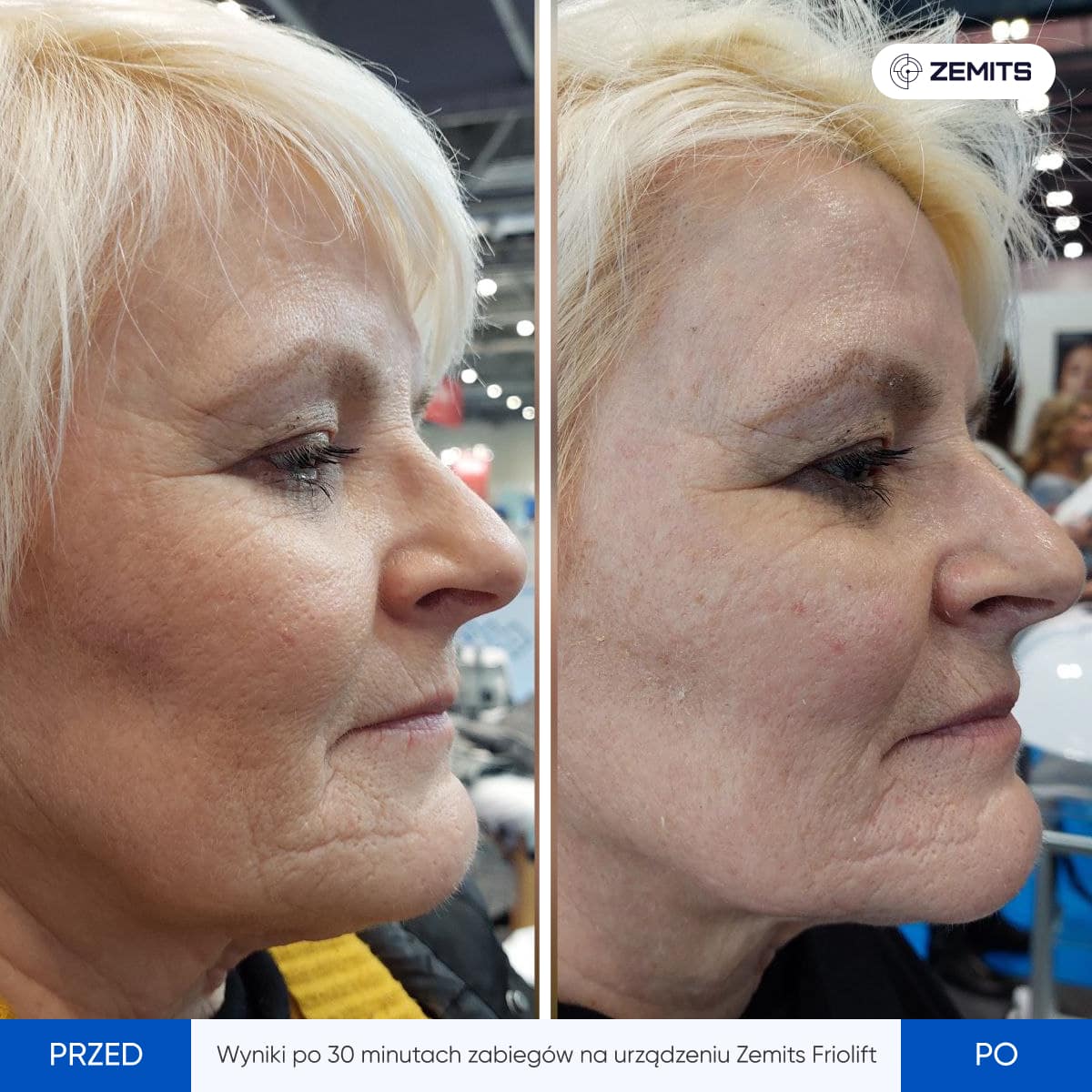 Before After Slide 16