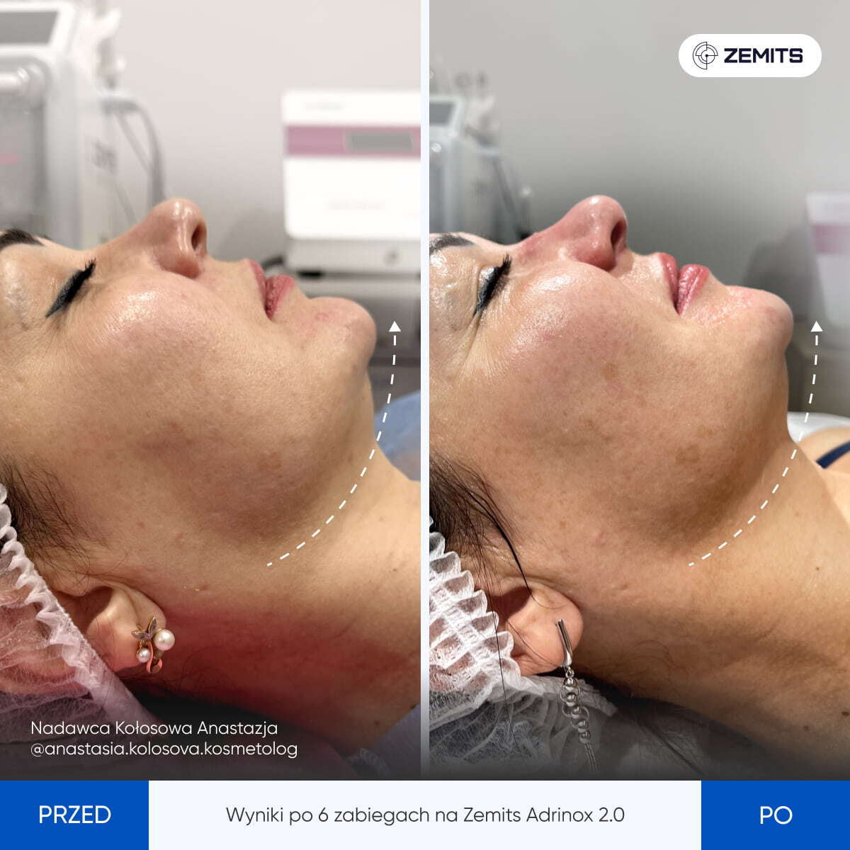 Before After Slide 10