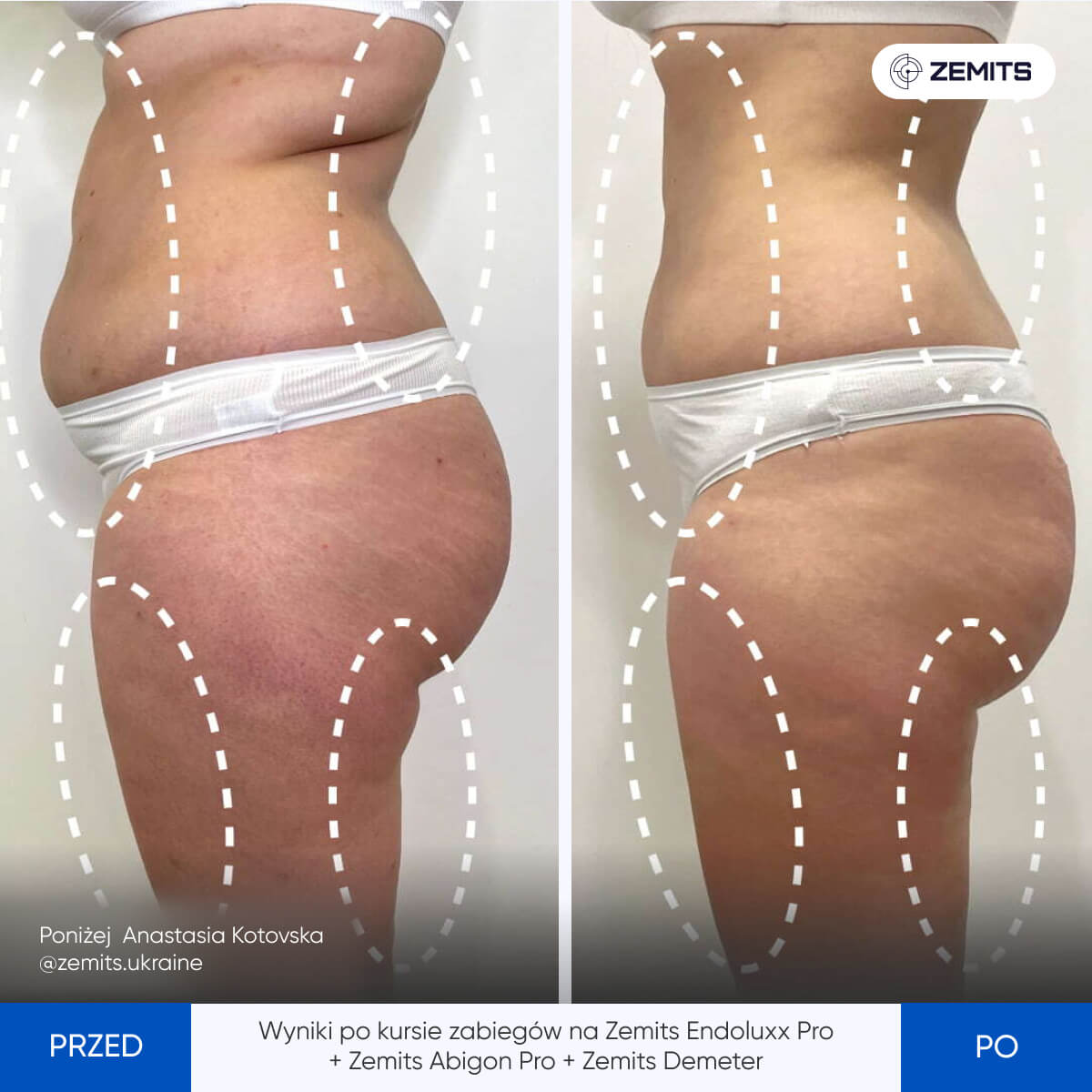 Before After Slide 3