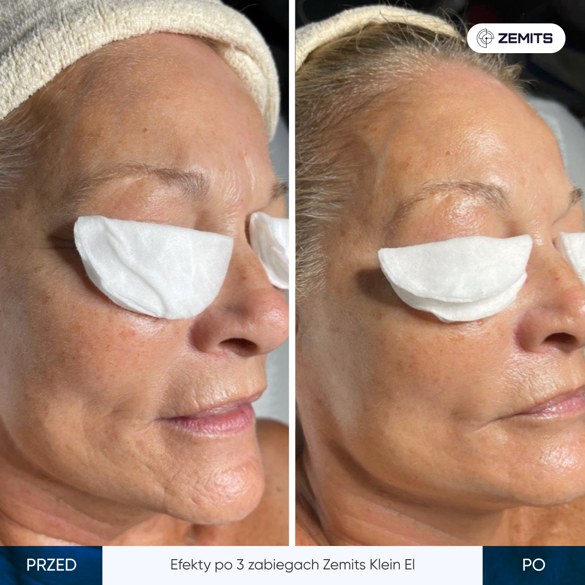 Before After Slide 6