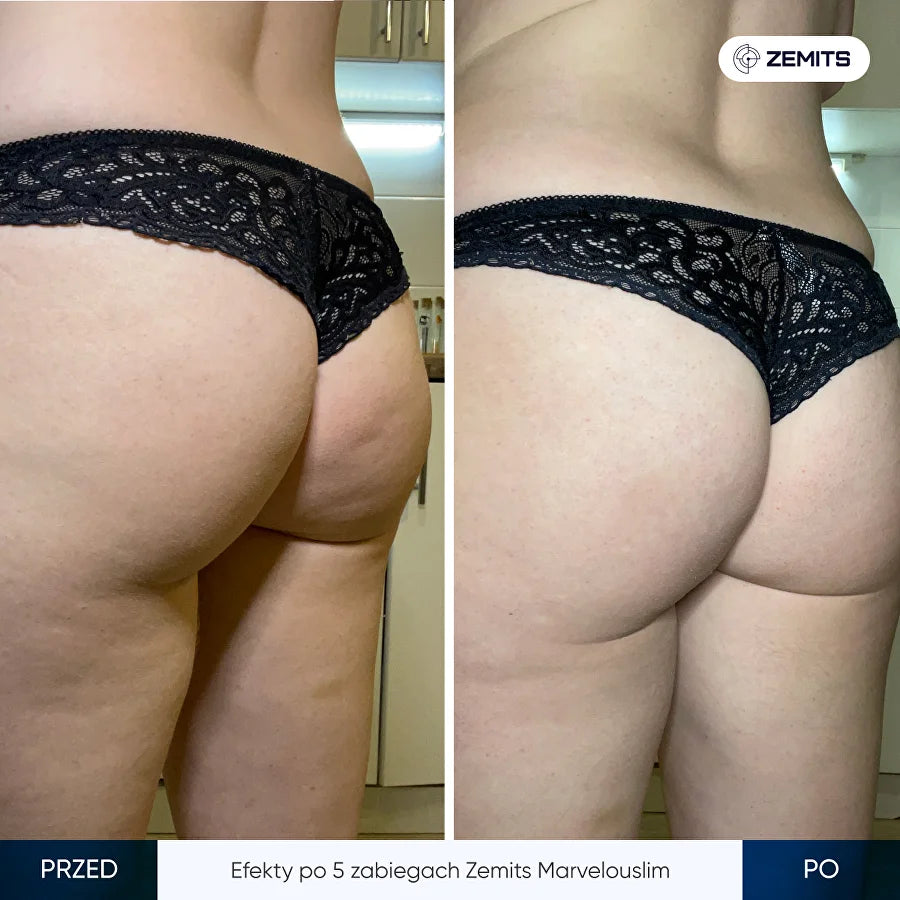 Before After Slide 1