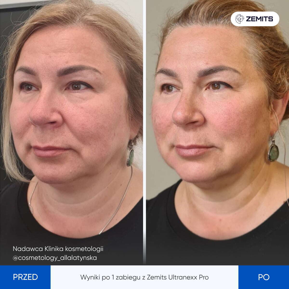 Zemits UltraNexx Pro