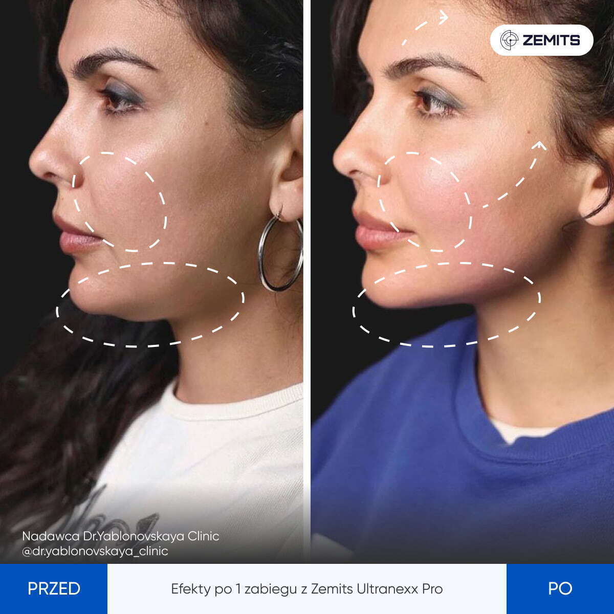 Zemits UltraNexx Pro
