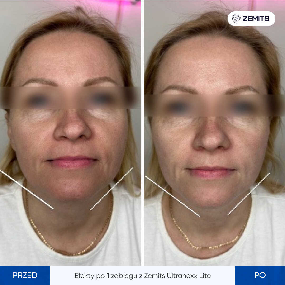 Before After Slide 4